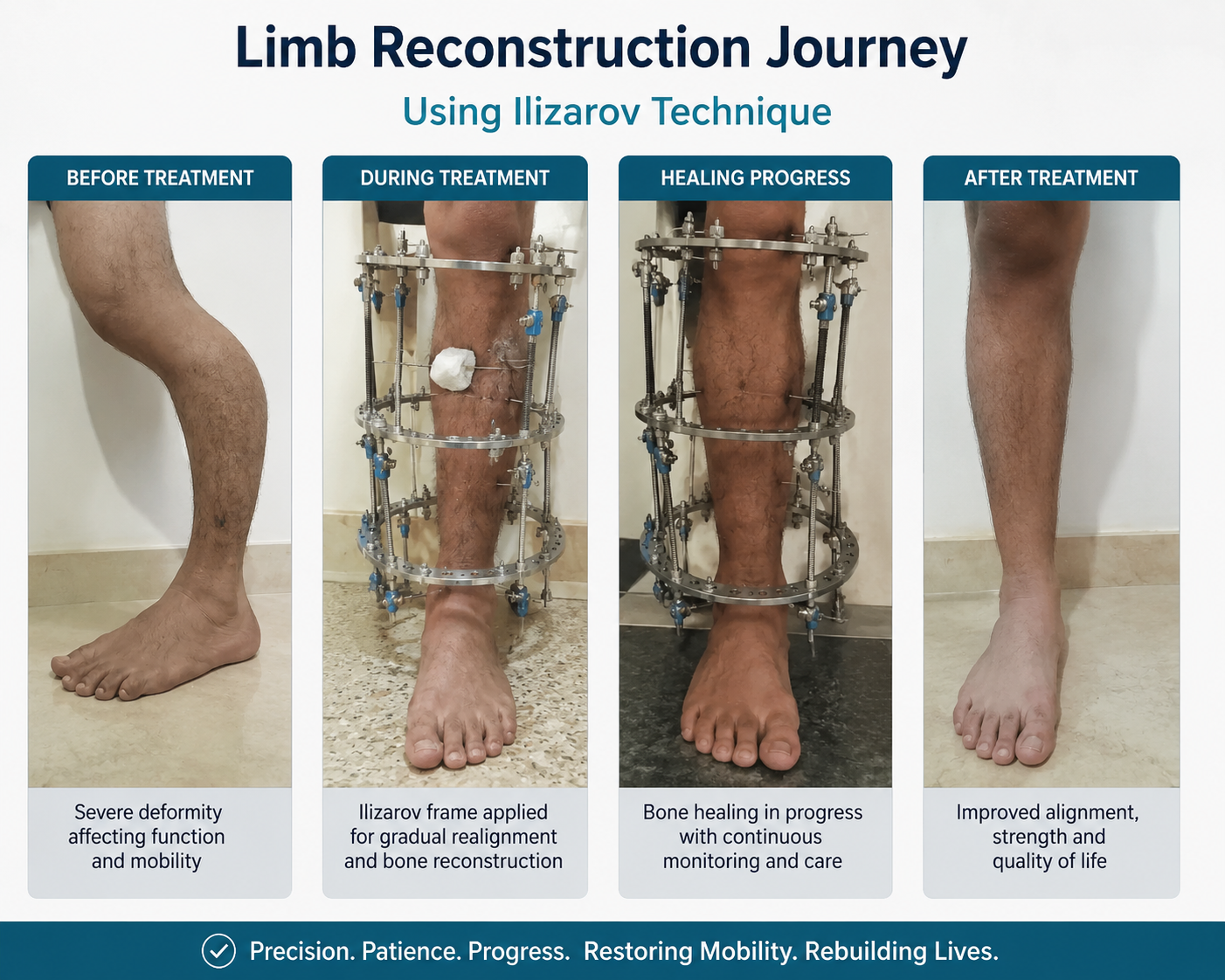 Ilizarov Bone Transport Procedure